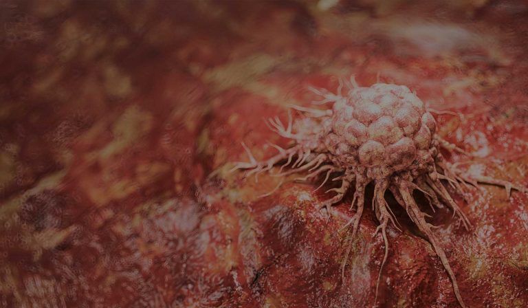 Stem cells supports the treatment of solid tumors